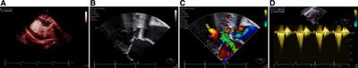 Case Report: Mechanical hemolysis resulting from left ventricular outflow tract obstruction after aortic valve replacement relieved by transapical beating-heart septal myectomy